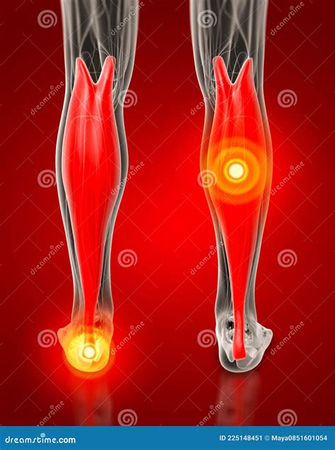 Medical Illustration Of The Gastrocnemius Stock Illustration