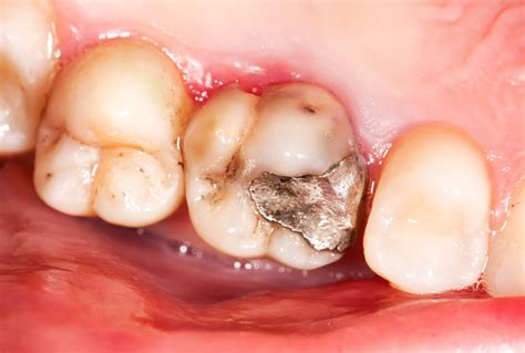 Decay Under A Dental Crown Patient Case Study Adler Cosmetic