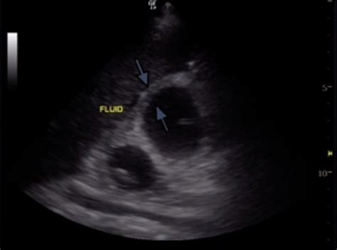 Ultrasound Leadership Academy: RUQ Ultrasound — EM Curious