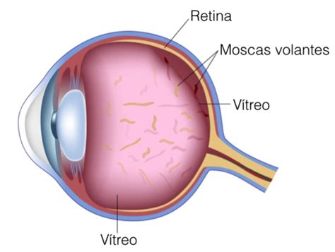 Descolamento do Vítreo e Moscas Volantes OftalmoCenter