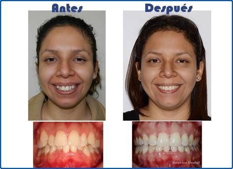 Fotos Antes Despu S Soluci N Dental