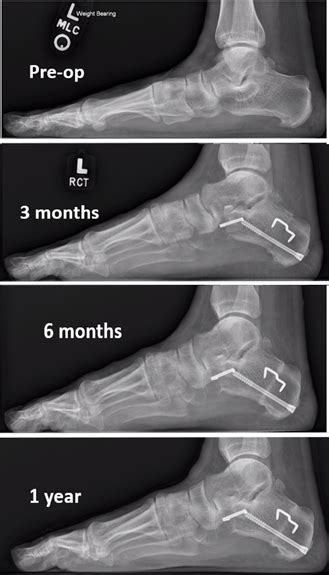 Flat Foot Correction Hotsell Bellvalefarms