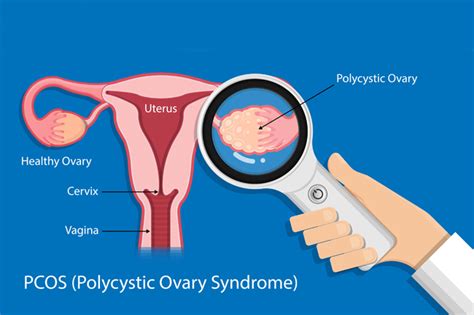 Sindrom Ovarium Polikistik Dan Faktor Risikonya Depok Pos