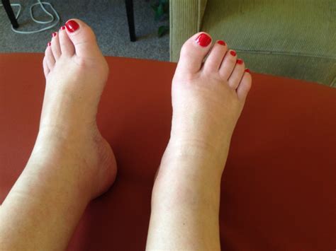 Foot And Ankle Swelling Change After Minutes Of Treating The