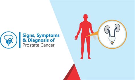 Signs Symptoms And Diagnosis Of Prostate Cancer Shifa International