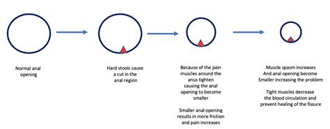Anal Fissure Dr Pallawipriya