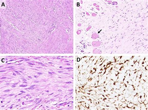 Histopathology Of Fibromatosis Cases A Low Magnification Shows Download Scientific Diagram