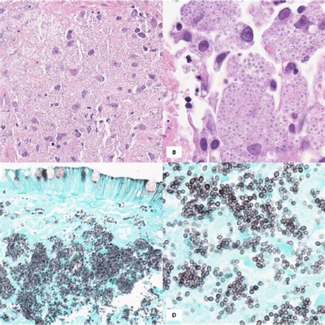 A B Hematoxylin Eosin Stain Of The Patients Colon Biopsy Download Scientific Diagram