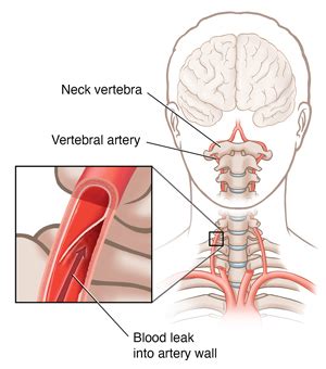 Understanding Vertebral Artery Dissection (VAD) | Saint Luke's Health ...