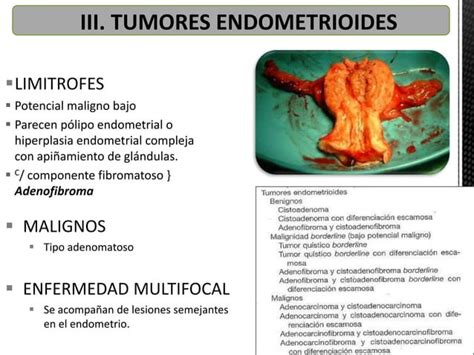 Tumores De Ovario Ppt