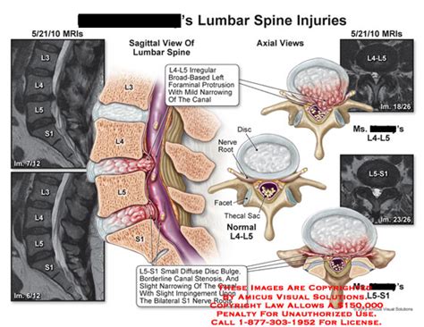 Amicus Illustration Of Amicusinjurylumbarspinebroad Basedforaminal