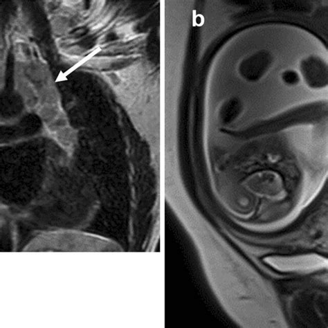 T2 Weighted Fast Spin Echo Fse And Ssfse Mr Scans Demonstrate Two Download Scientific Diagram