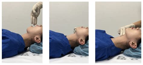 The “3 3 2 Rule” For Assessing The Airway Before Induction Of