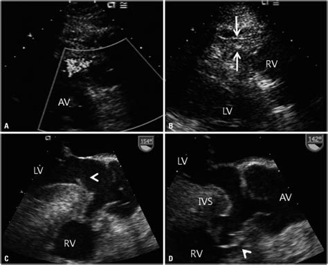 Preoperative Transthoracic And Transesophageal Echocardiography A Download Scientific