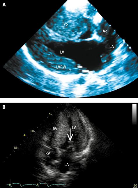 Figure 031_0556. Echocardiography of patients with hypertrophic ...