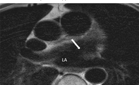 Pdf The Coumadin Ridge An Important Example Of A Left Atrial