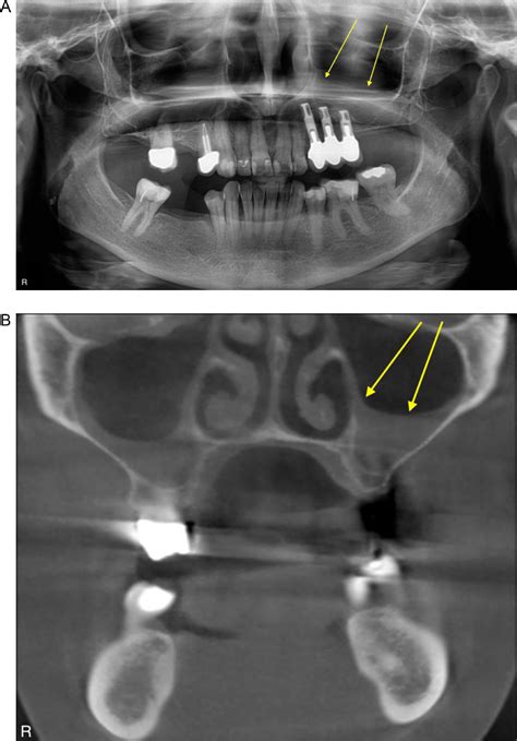 Panoramic Radiography Is Of Limited Value In The Evaluation Of