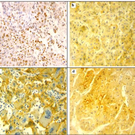 Immunohistochemical Expression Of Sox2 And Sox9 In Hepatocellular