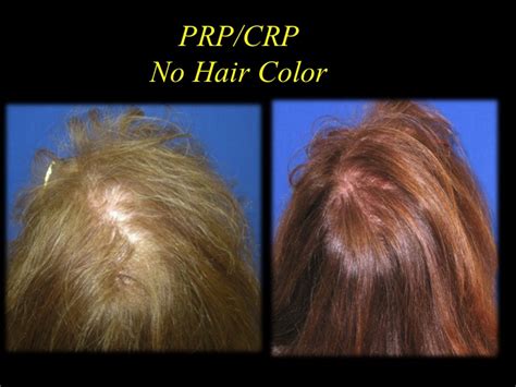 Hair Loss Prozac Medications That Cause Hair Loss List What You Can