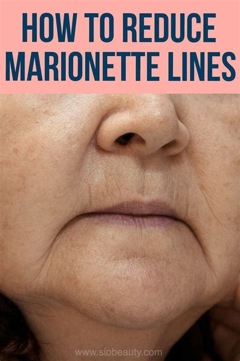 How To Reduce Marionette Lines On Face And Lips In 2024 Wrinkle