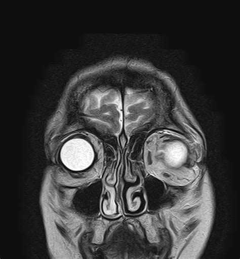 En Plaque Meningioma Sphenoid Wing Image Radiopaedia Org Hot Sex Picture