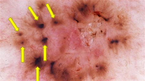 CARCINOMA BASOCELULAR Dra Emilia Cohen Sabban YouTube