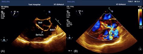 A Transesophageal Echo Short Axis View Shows Aortic Valve Right