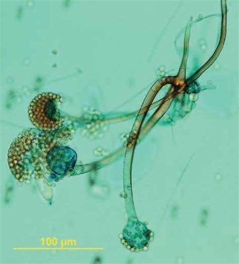 Figure 1 From Diagnosis Of Cutaneous Mucormycosis Due To Rhizopus