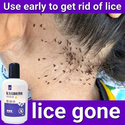 Ubat Kutu Rambut Kepala Syampoo Head Lice Hapuskan Kutu Kutu Kepala