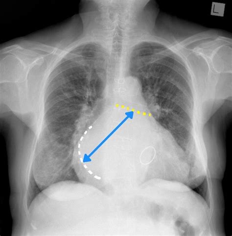 Left atrial enlargement | Radiology Case | Radiopaedia.org Size of the ...