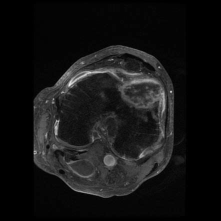 Intraosseous Tophaceous Gout Femur Image Radiopaedia Org