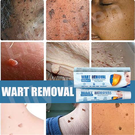 Amazingskin Warts Removal Ointment Wart Remover Original Cream