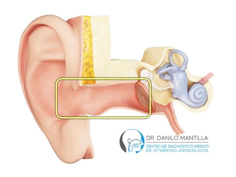 Otitis Externa Oído del nadador Dr Danilo Mantilla ORL