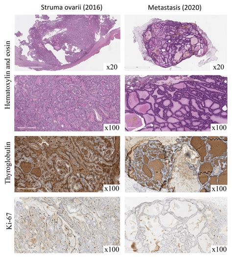 Morphology And Immunohistochemistry Of Ovarian Tumor And Peritoneal