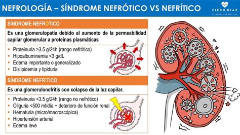 SINDROME NEFRÓTICO VS NEFRÍTICO pierodiaz med pierodiaz med uDocz