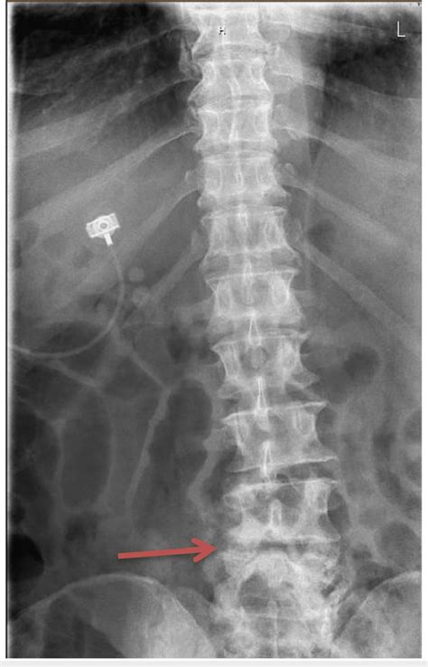 X Ray Of The Lumbar Spine Anteroposterior View Posterolisthesis Of