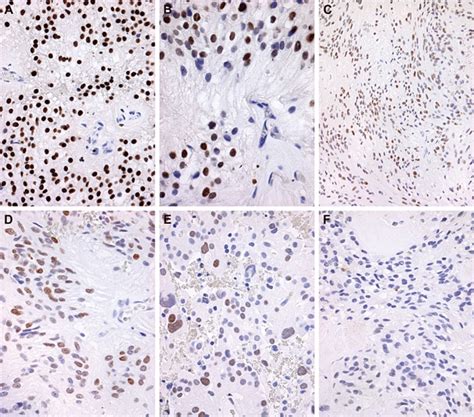 Representative Immunohistochemical Staining Of Homeobox B13 HOXB13