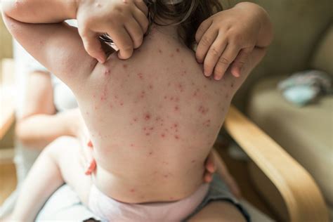 Can You Get Shingles If You Never Had Chickenpox