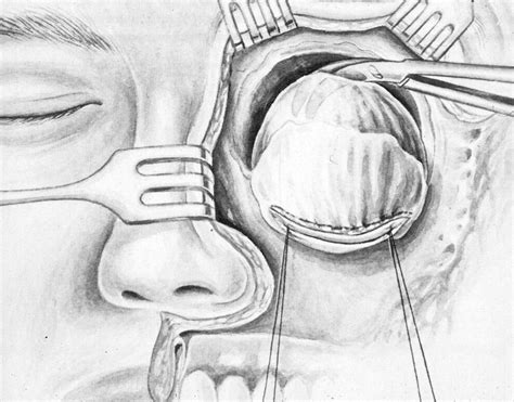 Traditional Craniofacial Resection Operative Techniques In