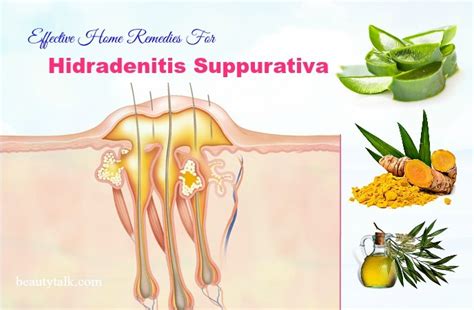 16 Effective Home Remedies For Hidradenitis Suppurativa That Work