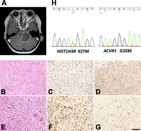 Frontiers Mgmt Expression Contributes To Temozolomide Resistance In