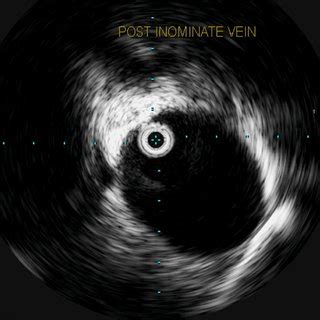 Intravascular ultrasound showing patent left innominate vein after ...