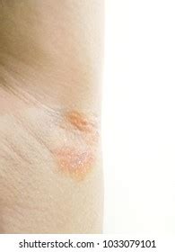 Armpit psoriasis : 18 images, photos et images vectorielles de stock | Shutterstock