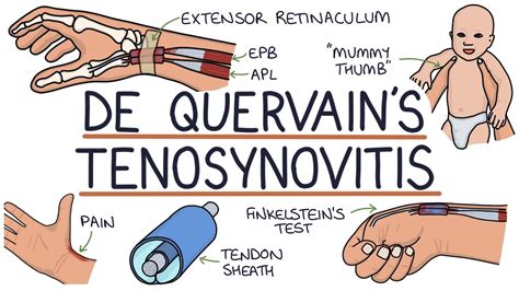 Understanding De Quervains Tenosynovitis Mummy Thumb Youtube