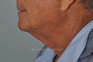 Neck Lift Archives Faces Pllc In Ridgeland Ms