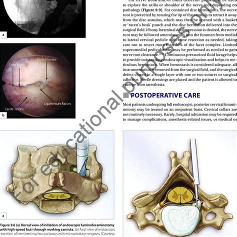 Pdf Chapter 09 Full Endoscopic Posterior Cervical Foraminotomy And