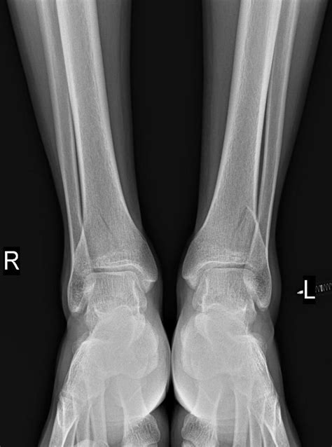 Filepilon Fracture Bilateral Radiopaedia 52423 58335 Frontal 1