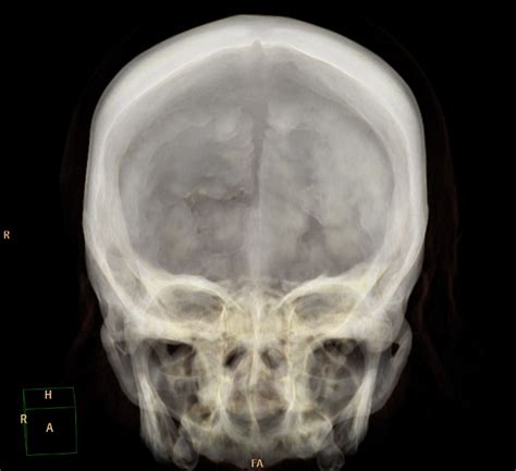 Hyperostosis Frontalis Interna Image