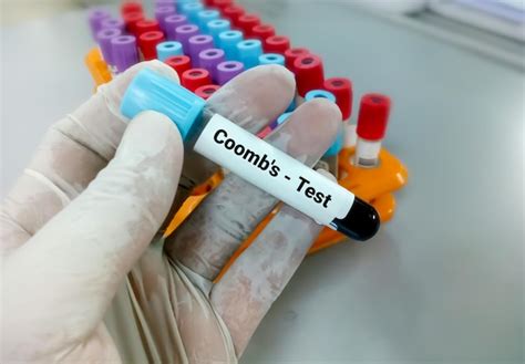 Amostra De Tubo De Sangue Para Teste De Coomb Para O Diagn Stico De