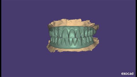 Upper Lower Full Arch Designing For Single Piece Basal Implants In